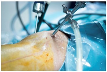 Orthopedic surgeries